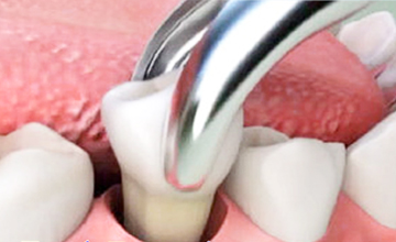 Bryan Dental Tooth Extractions service